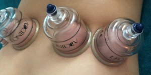 Les bienfaits de la thérapie par ventouses (cupping therapy)